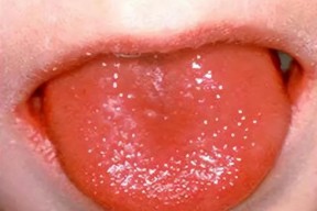 杨梅舌和草莓舌的区别 杨梅舌和草莓舌的区别在哪