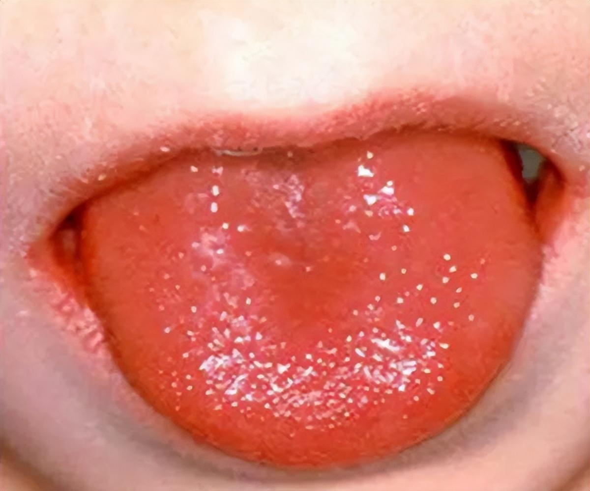 杨梅舌和草莓舌的区别 杨梅舌和草莓舌的区别在哪  第1张